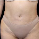 Liposuction Abdomen Before & After Patient #875