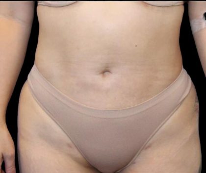 Liposuction Abdomen Before & After Patient #875