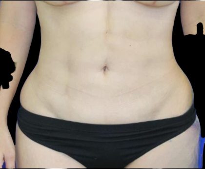 Liposuction Abdomen Before & After Patient #875