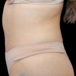 Liposuction Abdomen Before & After Patient #875