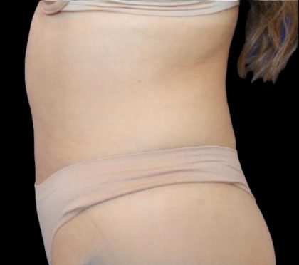 Liposuction Abdomen Before & After Patient #875