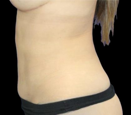 Liposuction Abdomen Before & After Patient #875