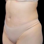 Liposuction Abdomen Before & After Patient #875