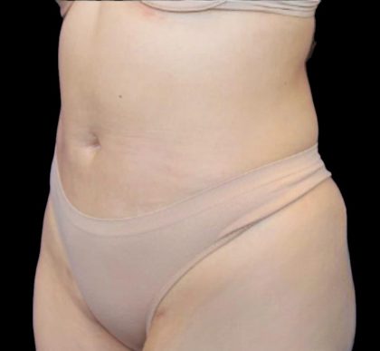 Liposuction Abdomen Before & After Patient #875