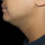 Neck Liposuction Before & After Patient #1035