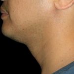 Neck Liposuction Before & After Patient #1035
