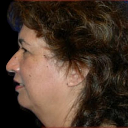 Neck Liposuction Before & After Patient #1036