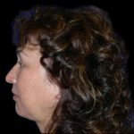 Neck Liposuction Before & After Patient #1036