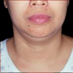 Neck Liposuction Before & After Patient #1037