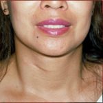 Neck Liposuction Before & After Patient #1037