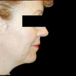 Neck Liposuction Before & After Patient #1038