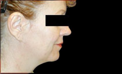 Neck Liposuction Before & After Patient #1038