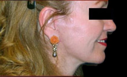 Neck Liposuction Before & After Patient #1038
