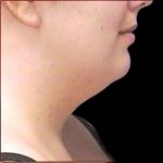 Neck Liposuction Before & After Patient #1039