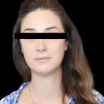 Neck Liposuction Before & After Patient #1040