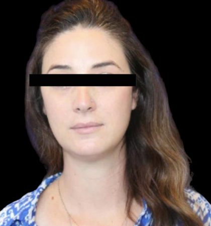 Neck Liposuction Before & After Patient #1040