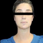 Neck Liposuction Before & After Patient #1040