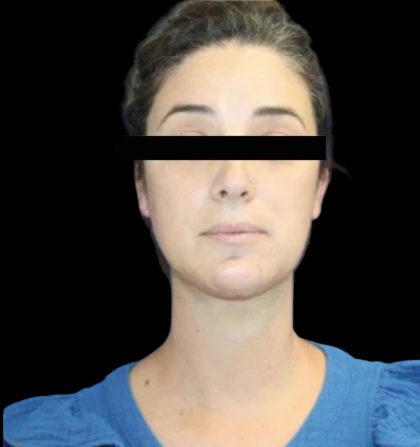 Neck Liposuction Before & After Patient #1040