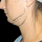 Neck Liposuction Before & After Patient #1042