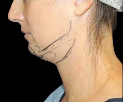 Neck Liposuction Before & After Patient #1042
