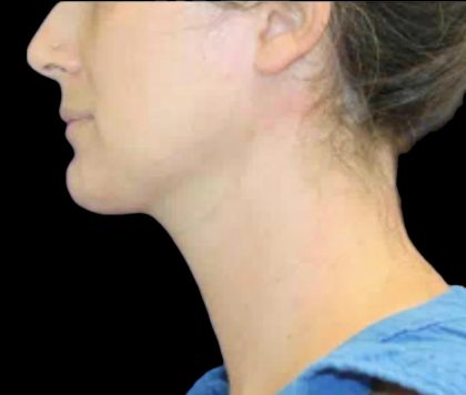 Neck Liposuction Before & After Patient #1042