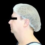 Neck Liposuction Before & After Patient #1043
