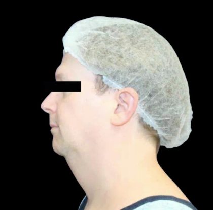 Neck Liposuction Before & After Patient #1043