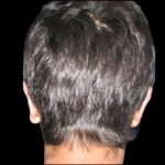 Otoplasty Before & After Patient #1045