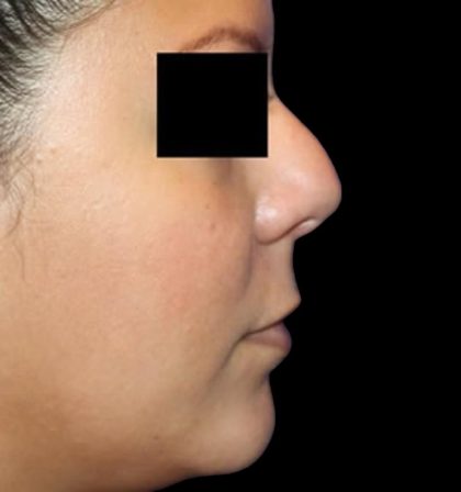 Rhinoplasty Before & After Patient #1046