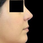 Rhinoplasty Before & After Patient #1046