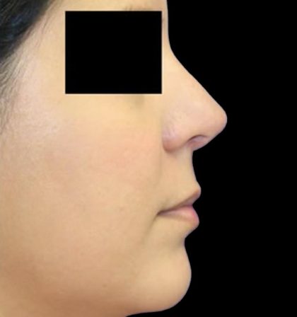 Rhinoplasty Before & After Patient #1046