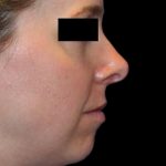 Rhinoplasty Before & After Patient #1047