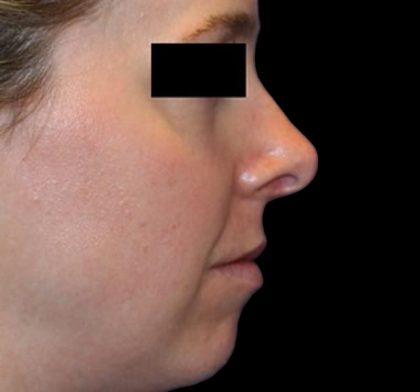 Rhinoplasty Before & After Patient #1047