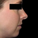 Rhinoplasty Before & After Patient #1047
