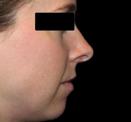 Rhinoplasty Before & After Patient #1047
