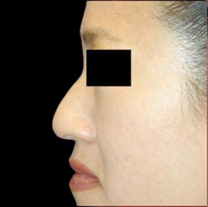 Rhinoplasty Before & After Patient #1048