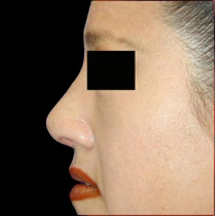 Rhinoplasty Before & After Patient #1048