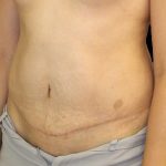 Tummy Tuck Before & After Patient #722