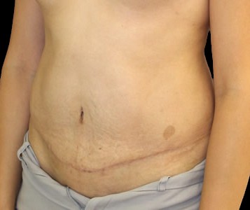 Tummy Tuck Before & After Patient #722