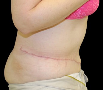 Tummy Tuck Before & After Patient #723