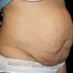 Tummy Tuck Before & After Patient #724