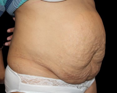 Tummy Tuck Before & After Patient #724