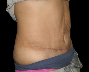 Tummy Tuck Before & After Patient #724