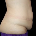 Tummy Tuck Before & After Patient #725