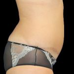 Tummy Tuck Before & After Patient #725