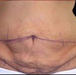Tummy Tuck Before & After Patient #726