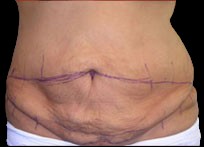 Tummy Tuck Before & After Patient #726