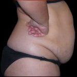 Tummy Tuck Before & After Patient #727