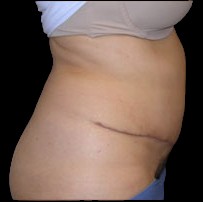 Tummy Tuck Before & After Patient #727
