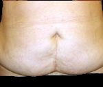 Tummy Tuck Before & After Patient #728